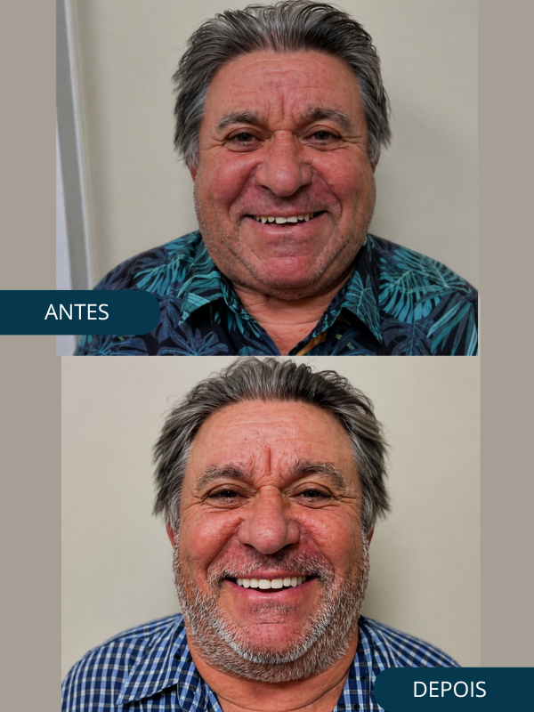 Antes e Depois - Odonto Help